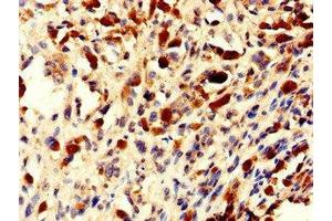 Immunohistochemistry of paraffin-embedded human melanoma using ABIN7154802 at dilution of 1:100 (NHP2 Antikörper  (AA 1-153))