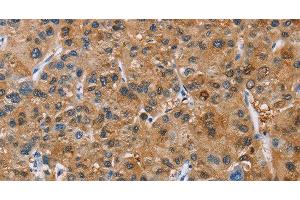 Immunohistochemistry of paraffin-embedded Human liver cancer tissue using NCR3 Polyclonal Antibody at dilution 1:40