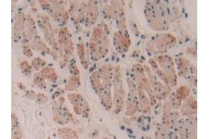 Detection of MYH16 in Human Esophagus cancer Tissue using Polyclonal Antibody to Myosin Heavy Chain 16 (MYH16) (MYH16 Antikörper  (AA 209-469))