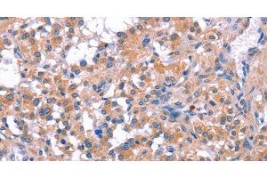 Immunohistochemistry of paraffin-embedded Human thyroid cancer tissue using ELP2 Polyclonal Antibody at dilution 1:40 (ELP2 Antikörper)