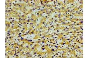 Immunohistochemistry of paraffin-embedded human liver cancer using ABIN7144407 at dilution of 1:100 (APOA5 Antikörper  (AA 260-366))