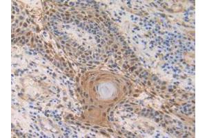 IHC-P analysis of Human Skin Cancer Tissue, with DAB staining. (S100A2 Antikörper  (AA 2-98))