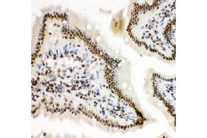 Immunohistochemistry (Paraffin-embedded Sections) (IHC (p)) image for anti-Hypoxia Inducible Factor 1, alpha Subunit (Basic Helix-Loop-Helix Transcription Factor) (HIF1A) (AA 703-732), (C-Term) antibody (ABIN3043841) (HIF1A Antikörper  (C-Term))