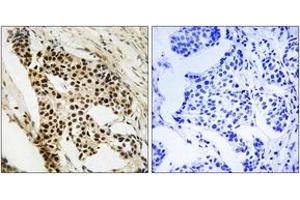 Immunohistochemistry analysis of paraffin-embedded human breast carcinoma tissue, using MAPKAPK2 (Ab-272) Antibody. (MAPKAP Kinase 2 Antikörper  (AA 238-287))