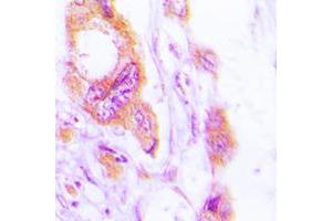 Immunohistochemical analysis of Cytokeratin 19 staining in human lung cancer formalin fixed paraffin embedded tissue section.