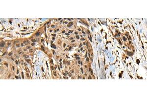 Immunohistochemistry of paraffin-embedded Human esophagus cancer tissue using CCDC113 Polyclonal Antibody at dilution of 1:65(x200) (CCDC113 Antikörper)