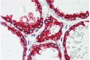 Human Thyroid (formalin-fixed, paraffin-embedded) stained with P4HB antibody ABIN396933 at 5 ug/ml followed by biotinylated anti-mouse IgG secondary antibody ABIN481714, alkaline phosphatase-streptavidin and chromogen. (P4HB Antikörper  (AA 499-509))