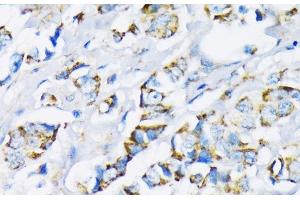 Immunohistochemistry of paraffin-embedded Human breast cancer using HK2 Polyclonal Antibody at dilution of 1:200 (40x lens). (Hexokinase 2 Antikörper)