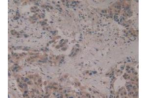 IHC-P analysis of Human Breast Cancer Tissue, with DAB staining. (CIRBP Antikörper  (AA 1-172))