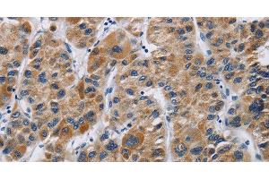 Immunohistochemistry of paraffin-embedded Human liver cancer using IFNGR2 Polyclonal Antibody at dilution of 1:40 (IFNGR2 Antikörper)