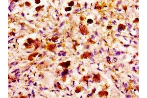 IHC image of ABIN7158974 diluted at 1:100 and staining in paraffin-embedded human melanoma performed on a Leica BondTM system. (MASP2 Antikörper  (AA 189-314))