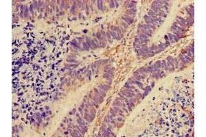 Immunohistochemistry of paraffin-embedded human ovarian cancer using ABIN7142793 at dilution of 1:100 (RPL28 Antikörper  (AA 2-137) (Biotin))