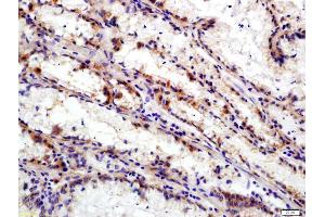 Formalin-fixed and paraffin embedded human gastric carcinoma labeled with Anti-Integrin Alpha V + Beta 6 Polyclonal Antibody, Unconjugated (ABIN714806) at 1:200 followed by conjugation to the secondary antibody and DAB staining