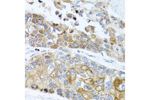 Immunohistochemistry of paraffin-embedded human lung cancer using PEX14 antibody (ABIN5975501) at dilution of 1/100 (40x lens). (PEX14 Antikörper)