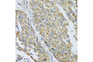 Immunohistochemistry of paraffin-embedded human lung cancer using CYP1A1 antibody (ABIN5971186) at dilution of 1/100 (40x lens). (CYP1A1 Antikörper)