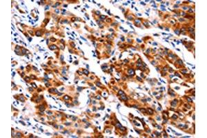 The image on the left is immunohistochemistry of paraffin-embedded Human lung cancer tissue using ABIN7192314(SEPT4 Antibody) at dilution 1/50, on the right is treated with synthetic peptide. (Septin 4 Antikörper)