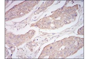 Immunohistochemical analysis of paraffin-embedded rectum cancer tissues using CD10 mouse mAb with DAB staining. (MME Antikörper  (AA 52-246))