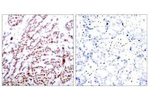 Immunohistochemical analysis of paraffin-embedded human breast carcinoma tissue using ATF2(Phospho-Thr73 or 55) Antibody(left) or the same antibody preincubated with blocking peptide(right).