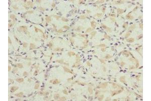 Immunohistochemistry of paraffin-embedded human gastric cancer using ABIN7165131 at dilution of 1:100 (Nerve Growth Factor Receptor (TNFRSF16) Associated Protein 1 (NGFRAP1) (AA 1-111) Antikörper)
