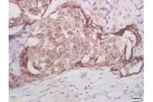 Formalin-fixed and paraffin embedded human breast cancer labeled with Rabbit Anti-AKT1/2/3 (Thr305/308/309) Polyclonal Antibody, Unconjugated (ABIN756052) at 1:200 followed by conjugation to the secondary antibody and DAB staining (AKT 1/2/3 Antikörper  (pThr305, pThr308, pThr309))