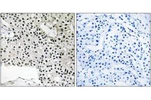 Immunohistochemistry analysis of paraffin-embedded human breast carcinoma, using TCEAL4 Antibody. (TCEAL4 Antikörper  (AA 166-215))