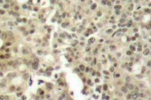 Immunohistochemistry (IHC) analyzes of PKC delta antibody in paraffin-embedded human breast carcinoma tissue. (PKC delta Antikörper)