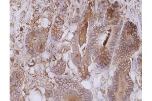 Immunohistochemistry staining of colorectal carcinoma (paraffin-embedded sections) with anti-human CD66e (CB30). (CEACAM5 Antikörper)