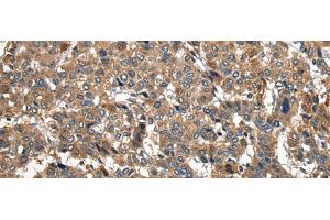 Immunohistochemistry of paraffin-embedded Human liver cancer tissue using PIWIL2 Polyclonal Antibody at dilution of 1:30(x200) (PIWIL2 Antikörper)