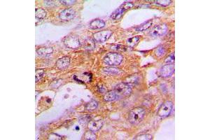 Immunohistochemical analysis of Caspase 9 staining in human lung cancer formalin fixed paraffin embedded tissue section. (Caspase 9 Antikörper  (Center))