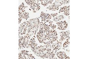 Immunohistochemical analysis of paraffin-embedded Human breast carcinoma tissue using (ABIN6243675 and ABIN6577401) performed on the Leica® BOND RXm. (GLI2 Antikörper  (C-Term))