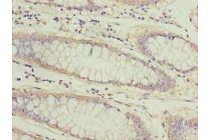 Immunohistochemistry of paraffin-embedded human colon cancer using ABIN7144813 at dilution of 1:100 (ATL2 Antikörper  (AA 1-300))