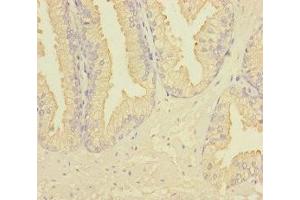 Immunohistochemistry of paraffin-embedded human prostate cancer using ABIN7167274 at dilution of 1:100 (RAB27B Antikörper  (AA 1-218))