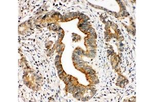 IHC-P: Integrin alpha 3 antibody testing of human intestinal cancer tissue (ITGA3 Antikörper  (N-Term))