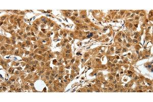 Immunohistochemistry of paraffin-embedded Human lung cancer using SOX-13 Polyclonal Antibody at dilution of 1:50 (SOX13 Antikörper)