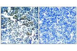 Immunohistochemical analysis of paraffin-embedded human tonsil tumor tissue, using Bcr (phospho-Tyr177) antibody (E011199). (BCR Antikörper  (pTyr177))