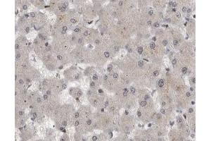 ABIN6267594 at 1/200 staining human liver cancer tissue sections by IHC-P. (MEK1 Antikörper  (pSer221))