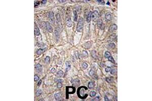 Formalin-fixed and paraffin-embedded human prostate carcinoma tissue reacted with CDH3 polyclonal antibody  , which was peroxidase-conjugated to the secondary antibody, followed by DAB staining. (P-Cadherin Antikörper  (C-Term))