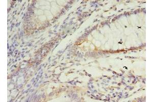 Immunohistochemistry of paraffin-embedded human colon cancer using ABIN7172922 at dilution of 1:100