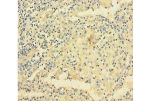 Immunohistochemistry of paraffin-embedded human lung cancer using ABIN7175481 at dilution of 1:100 (VAMP5 Antikörper  (AA 1-72))