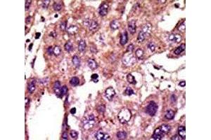 IHC analysis of FFPE human hepatocarcinoma stained with the AMFR antibod (AMFR Antikörper  (AA 571-601))