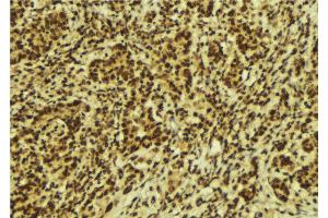 ABIN6274165 at 1/100 staining Human breast cancer tissue by IHC-P. (Topoisomerase II alpha Antikörper  (Internal Region))