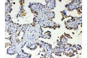 IHC testing of FFPE human lung cancer tissue with ETV6 antibody at 1ug/ml. (ETV6 Antikörper)