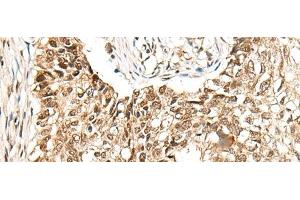 Immunohistochemistry of paraffin-embedded Human lung cancer tissue using CCDC181 Polyclonal Antibody at dilution of 1:50(x200) (C1orf114 Antikörper)