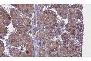 ABIN6272762 at 1/100 staining Human liver cancer tissue by IHC-P.