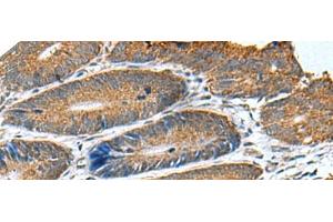 Immunohistochemistry of paraffin-embedded Human colorectal cancer tissue using HSD11B1 Polyclonal Antibody at dilution of 1:70(x200) (HSD11B1 Antikörper)