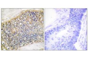 Immunohistochemistry analysis of paraffin-embedded human colon carcinoma tissue using TALL-2 antibody. (TNFSF13 Antikörper  (Internal Region))