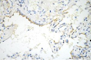 Immunohistochemistry was performed on paraffin-embedded human lung adenocarcinoma using phospho-EGFR (Y) antibody (ABIN7798468), 1:200). (Rekombinanter EGFR Antikörper  (pTyr1068))