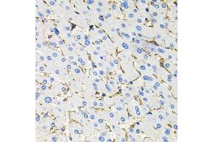 Immunohistochemistry of paraffin-embedded human liver damage using Somatostatin Receptor 2 (SSTR2) antibody (ABIN3017442, ABIN3017443, ABIN3017444 and ABIN6220093) at dilution of 1:100 (40x lens). (SSTR2 Antikörper  (C-Term))