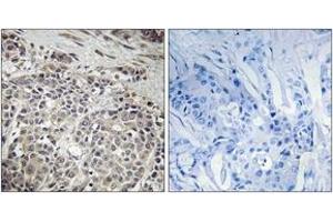 Immunohistochemistry analysis of paraffin-embedded human breast carcinoma tissue, using AMPK1 (Ab-485) Antibody. (PRKAA1 Antikörper  (AA 451-500))