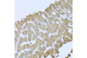 Immunohistochemistry of paraffin-embedded human liver injury using ACP1 antibody at dilution of 1:100 (x40 lens).